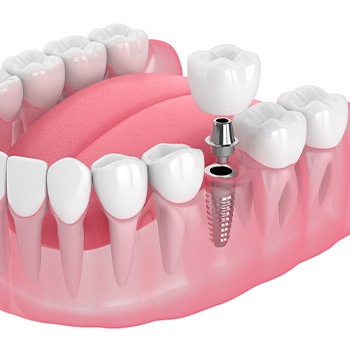 Illustration of a single dental implant