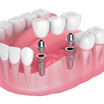 Illustration of an implant bridge