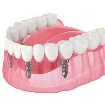 Illustration of an implant denture