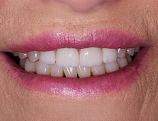 Close up of smile with gaps closed