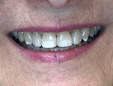 Close up of brightened teeth