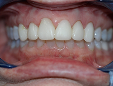 Close up of whitened smile