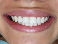 Teeth after dental treatment