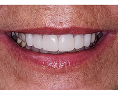Teeth after dental treatment