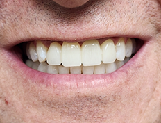 Teeth after dental treatment
