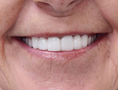 Teeth after dental treatment