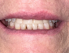Close up of gapped teeth