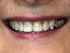 Close up of yellowed teeth