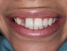 Teeth before dental treatment