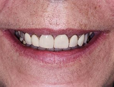 Teeth before dental treatment