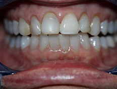 Close up of dull smile