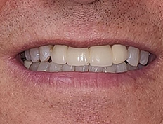 Teeth before dental treatment