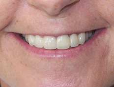 Teeth before dental treatment