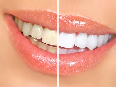 Closeup of a smile with sparkly gloss that’s halved to show effects of teeth whitening