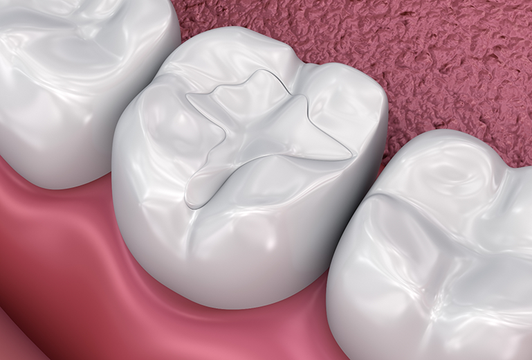 Illustration of a tooth with a filling