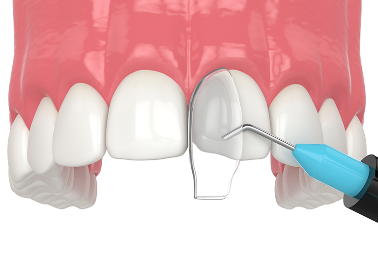 Illustration of teeth receiving cosmetic bonding