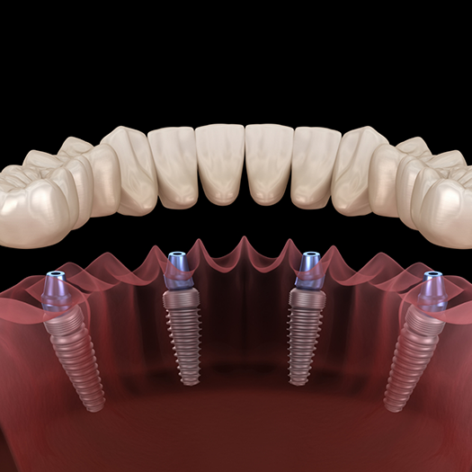 Illustration of full implant dentures
