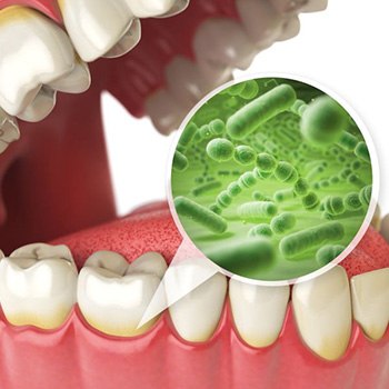 Illustration showing bacteria along gumline