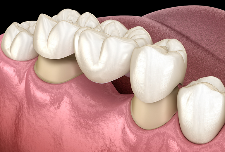 Illustration of dental bridge being used to replace missing teeth in Coppell