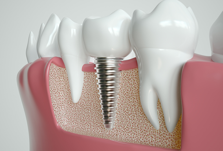 Model of dental implant inserted into gums