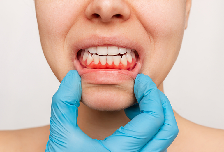 Pulling down lips to show inflamed gums