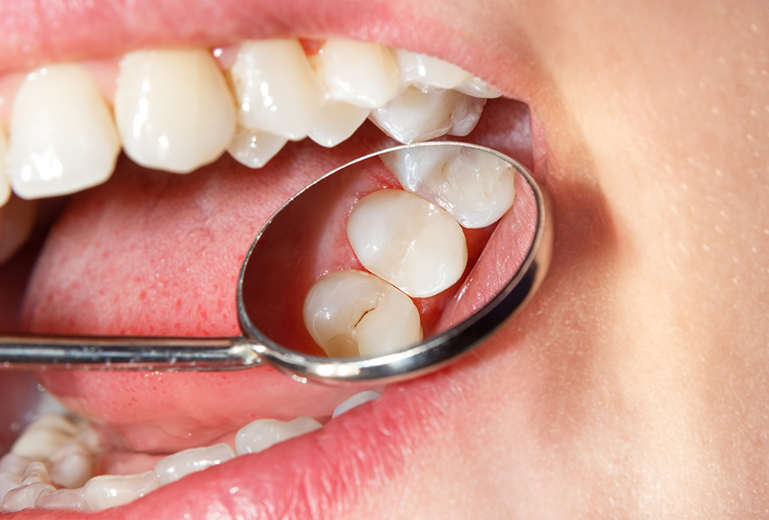 Dental mirror being used to examine tooth