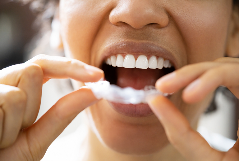 Woman about to put in nightguard for bruxism