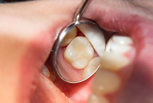 Tooth-colored filling reflected in dental mirror