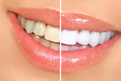 Understanding the cost of teeth whitening is important when selecting a treatment
