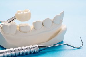 Dental crown held by tweezers over model teeth with light blue background